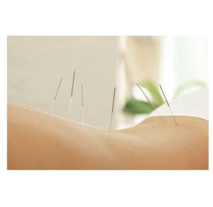 Photo of someone having acupuncture treatment with needles